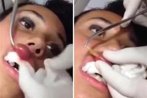 恐怖！這女子的嘴巴有天突然腫得跟香腸一樣，後來給醫生檢查之後…居然夾出了一隻蛆？！原來她得了...太可怕了！ 
