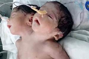 印度「罕見雙頭男嬰」出生時健康被醫生稱為奇蹟，但爸媽不理醫生建議變成悲劇。