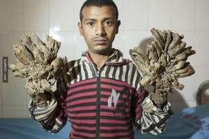 孟加拉「樹人」經過16次手術終於割掉11公斤的疣，他現在的手長這樣…