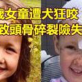 4歲女童遭犬狂咬到導致頭骨碎裂險失明