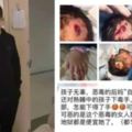 （氣憤！5歲男童熟睡中竟被爸爸懷孕女友毒打，鎚子猛擊，傷口深見頭骨！）