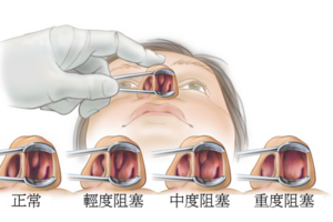 以前都不知道，原來鼻塞可以這麼簡單解決！這幾招學起來就可以暢快呼吸...