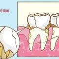 勸人洗牙是「消費套路」嗎？