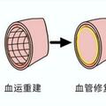 除了心臟支架植入，還有哪些新的介入技術？