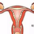 ​輸卵管堵塞的症狀與宮外孕的警示：理解生殖健康的兩大關鍵