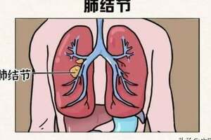 長了肺結節不要怕，醫生教你黃芪搭配煮水，輕鬆搞定它