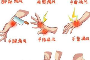 痛風急性期的用藥宜忌，這12種常用消炎鎮痛治療藥物您用對了嗎？