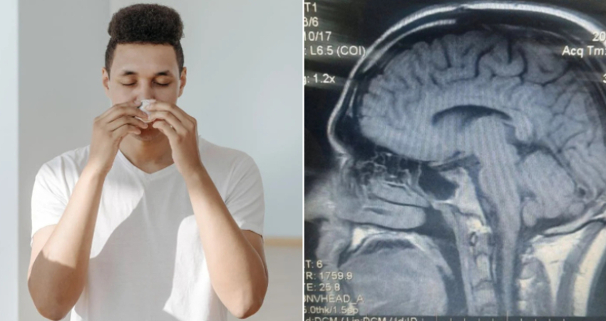 男子鼻涕狂流6年　就醫檢查竟是「大腦漏水」