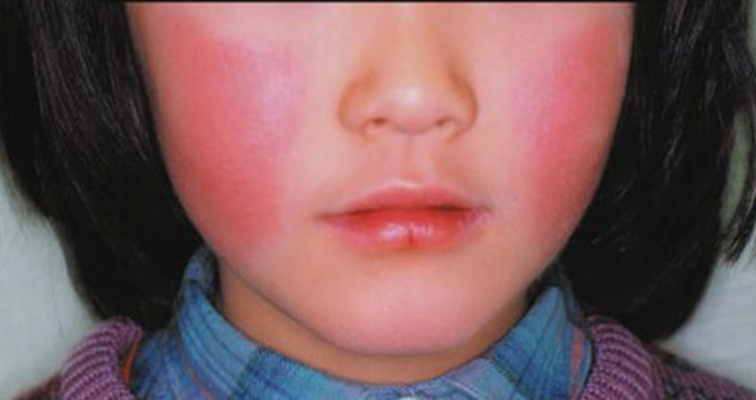 去日本小心「蘋果病創新高」　症狀、傳染途徑一次看