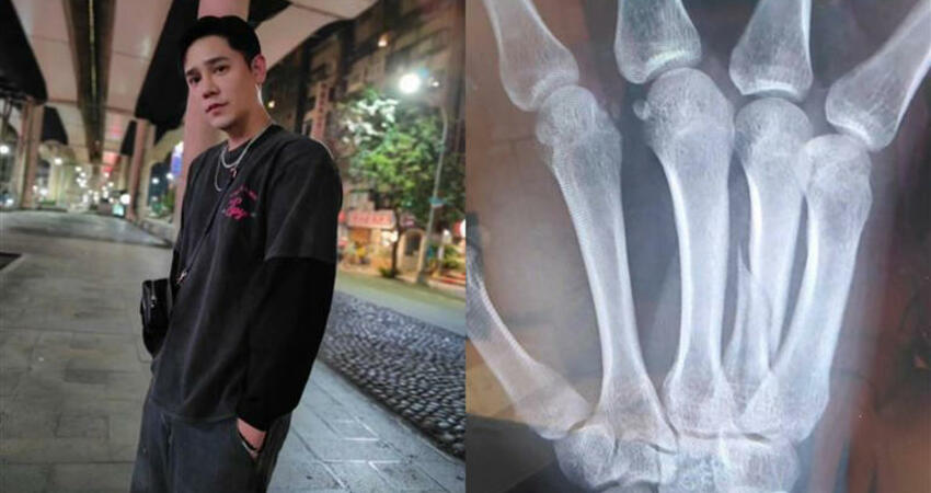 《星光幫》男星驚爆「打球骨折」 包石膏畫面流出嘆：想快點卸下