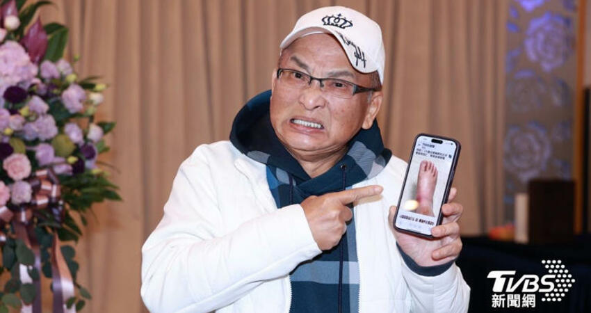 66歲孔鏘腳浮腫「好怕截肢」！3怪病纏身突發作 查不出病因