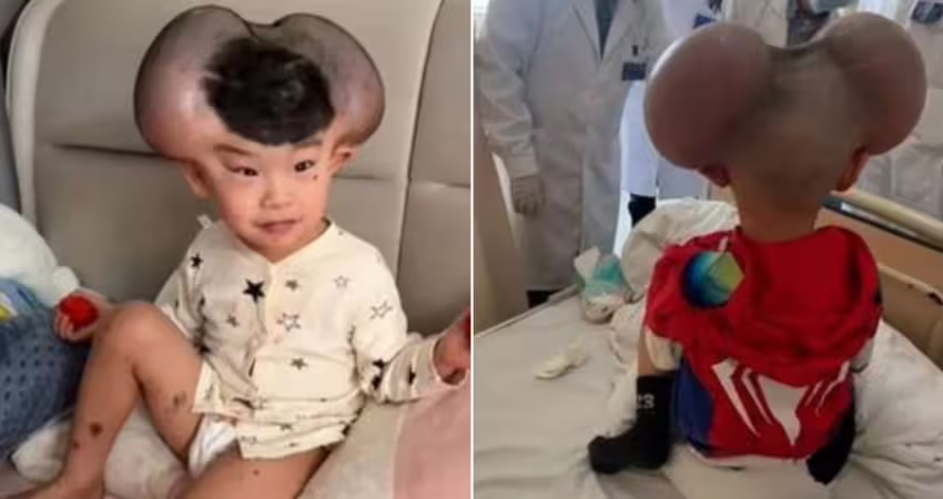 3歲童罹罕病頭上長巨痣　手術成功他終於笑了