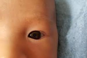 別大意！3歲女童眼中有白點！就醫發現竟是眼癌!