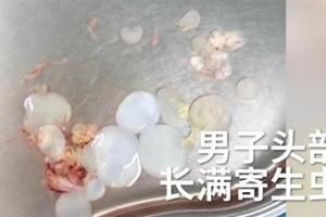 男頭痛嘔吐　驚見寄生蟲覆蓋大腦神經