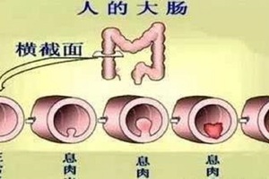 大腸癌發現時已是晚期，哪些癥狀暗示「大腸癌」？如果突然出現「四個癥狀」要注意，最好去醫院做檢查