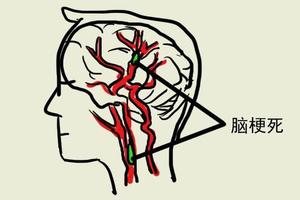 醫生提醒：如果睡覺時有這種表現可能是「中風前兆」，千萬要注意！