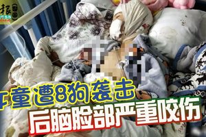 女童遭8狗袭击 后脑脸部严重咬伤