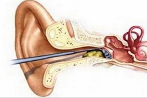 千萬不要再用「棉花棒」掏耳朵了！醫生說繼續用棉花棒最後就會變成這樣...太可怕了！