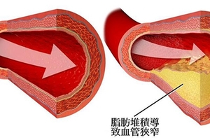 老中醫教您清理血管不吃藥不花錢太妙了，能讓血管更年輕、更健康！