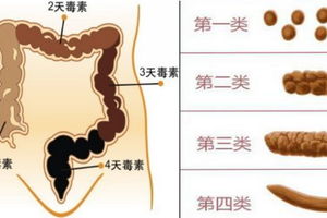 人體宿便有10斤？教你一分錢都不用花就能清腸排宿便！