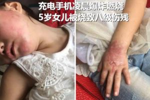 手機爆炸致5歲女孩八級傷殘，手機電池爆出來燃燒，滿臉漆黑，手也燒傷了索賠175萬元