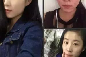 不同膚質的人祛痘方法不一樣，所以小豆芽老師要求先發照片診斷