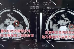 男子出現咖啡色血尿不痛未理，直至劇痛就醫才知結石堵住輸尿管