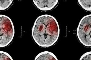 腦出血後怎麼血壓控制？早期降壓治療：130-140 mmHg最科學