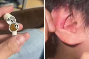 戴中國熱銷藍牙耳機 突在男大生耳內爆炸!專家揭真相了 戴中國熱銷藍牙耳機 突在男大生耳內爆炸!專家揭真相了