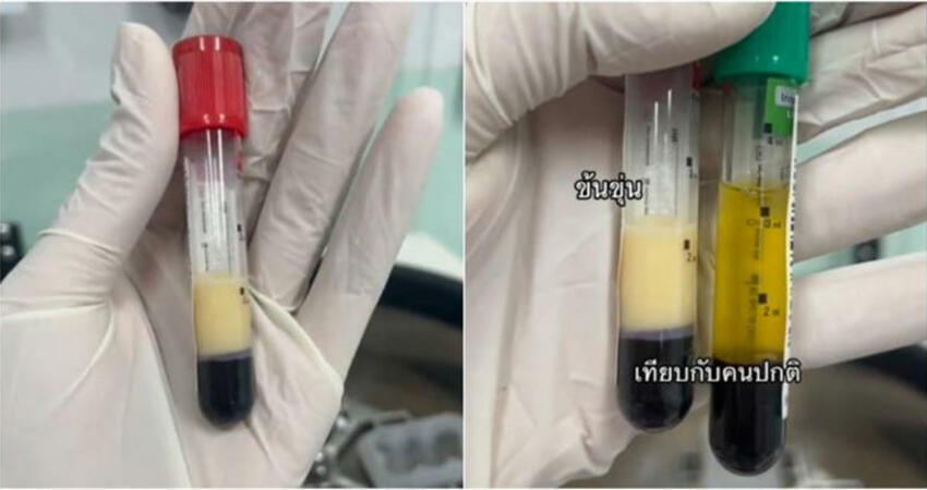 酗酒男送醫抽出「牛奶血」 醫揭啤酒肚成因：等於直接喝油