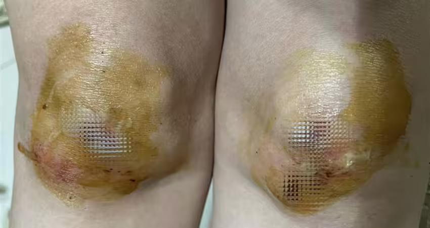 本土女星出事了！膝蓋「雙腳跪地重摔」 發炎腫脹吃止痛藥硬撐上工
