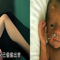 孕婦陣痛36小時 剖腹時竟不見寶寶 醫生和媽媽都嚇壞了