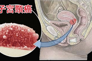 「子宮頸癌」有救了！這個我們「常吃的菜」竟可殺死多它100倍的子宮頸癌細胞！！一定要分享出去！！