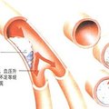 凈化血液的「完美食品」逆轉血管硬化