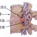 避免腰間盤突出，這6種運動不能練！