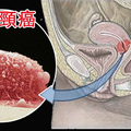 「子宮頸癌」有救了！這個我們「常吃的菜」竟可殺死多它100倍的子宮頸癌細胞！！