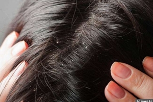 頭皮屑老是困擾你嗎？這3種方法比去屑洗髮精更有用！學起來，就不怕雪花老是飄在頭毛上了！