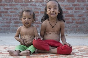 印度這對姊弟罹患一種罕見疾病使他們「一出生就比爸媽還老」。看完他們的可憐遭遇我鼻酸到不行…