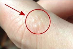 「手指」突然長出這種小水泡，小心是大病！