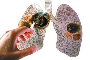 肺癌的七個症狀　不可不慎