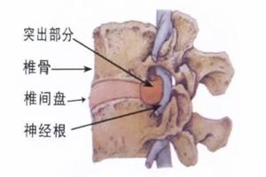 避免腰間盤突出，這6種運動不能練！