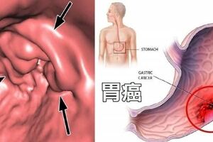 醫生勸告：早晨空腹時，千萬別碰這2種食物，會損傷胃粘膜，並加重原有的胃痛！