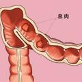 一次腸鏡能管多少年？5年還是10年？腸癌發生時，身體有3個預警