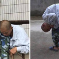 臉貼膝蓋30年！46歲男患詭病成「摺疊人」　經5次手術驚人現況曝