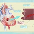 心慌、心悸，可能是心臟的「牆」出了問題