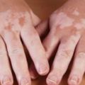 8種皮膚傳遞的「身體警訊」，突然長出大量「會痛的痣」要注意！