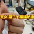 輕忽鼻竇炎男子大量腦部膿瘍險死