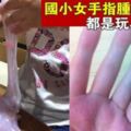 【新型玩具的隱藏危機!!】每天玩史萊姆！國小女手指腫成香腸，指紋不見了，醫檢：過敏性的接觸性皮膚炎