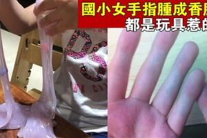 【新型玩具的隱藏危機!!】每天玩史萊姆！國小女手指腫成香腸，指紋不見了，醫檢：過敏性的接觸性皮膚炎