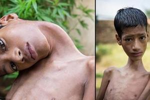 頭部只能掛胸前的印度男孩8個月前才手術成功正著看世界，現在他去世了...